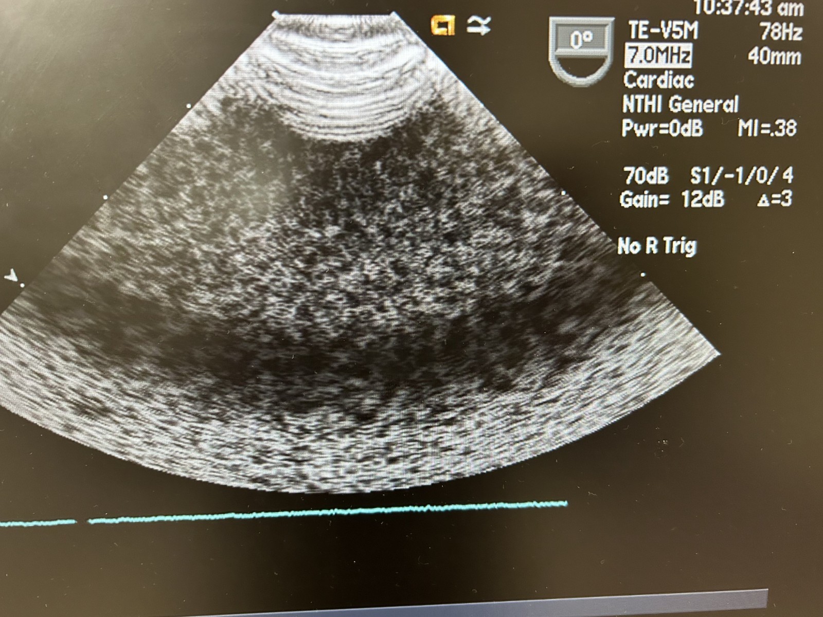 SIEMENS/ACUSON TE-V5Ms Transesophageal Echo TEE Ultrasound Transducer and Case